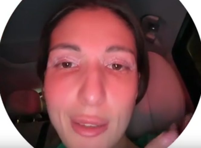 Яна Захарова сделала блефаропластику